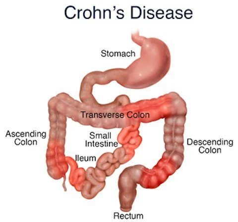 crohns disease
